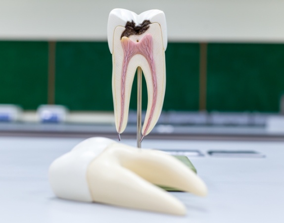 Model of damaged tooth that could use root canal treatment