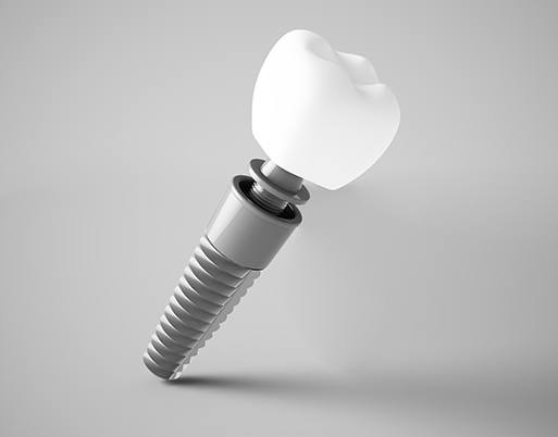 Digital image of dental implant parts