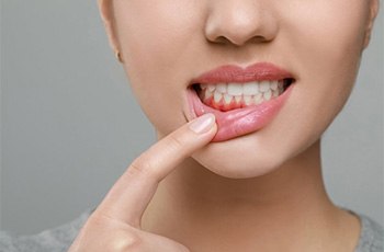 A woman showing signs of gum disease