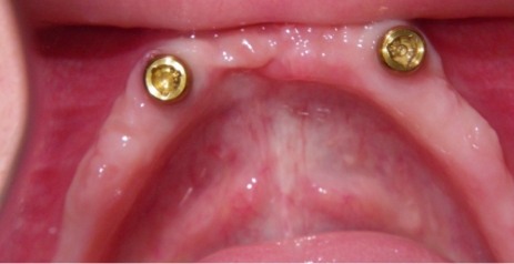 Close up of mouth after replacing missing teeth with dental implants