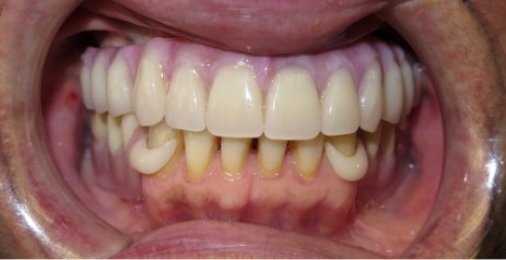 Close up of mouth after replacing missing teeth with dental implants