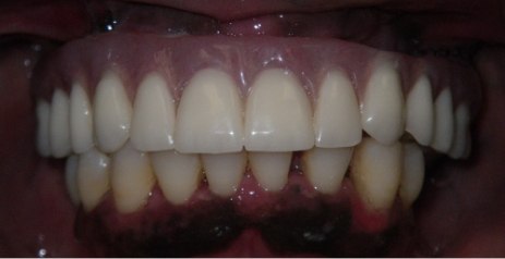 Close up of mouth after replacing missing teeth with dental implants