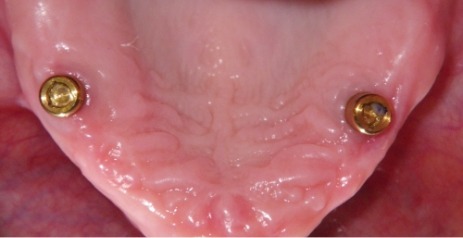 Close up of mouth with missing teeth