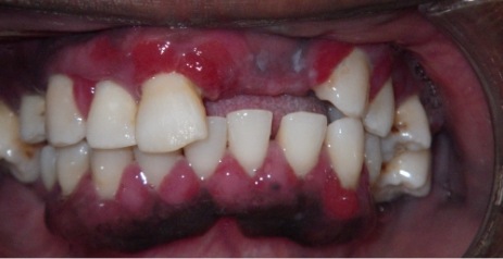 Close up of mouth with missing teeth