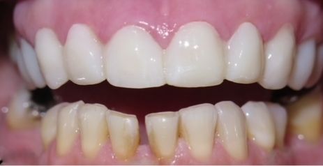 Close up of flawless teeth after dental treatment