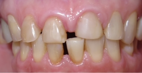 Close up of imperfect teeth before dental treatment