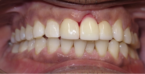 Close up of flawless teeth after dental treatment