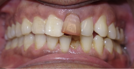 Close up of imperfect teeth before dental treatment