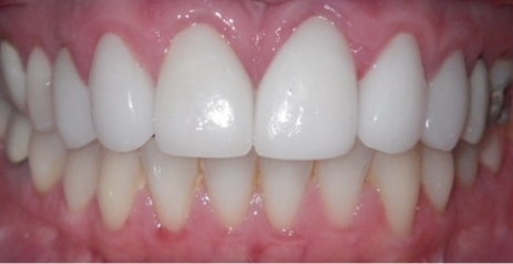 Close up of flawless teeth after dental treatment