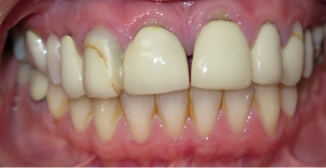 Close up of imperfect teeth before dental treatment