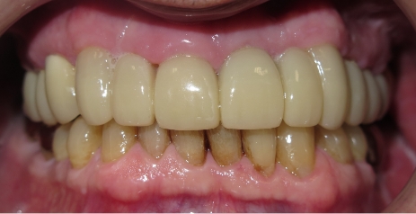 Close up of flawless teeth after dental treatment