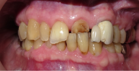 Close up of imperfect teeth before dental treatment