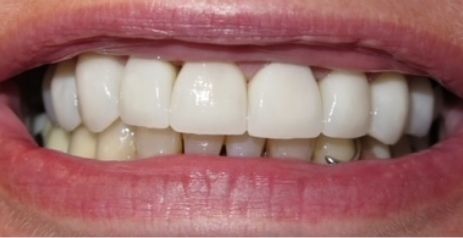 Close up of flawless teeth after cosmetic dentistry