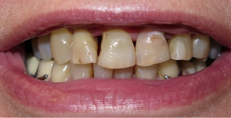 Close up of imperfect teeth before cosmetic dentistry in Charlotte