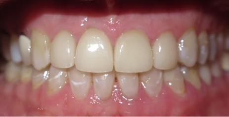 Close up of flawless teeth after dental treatment