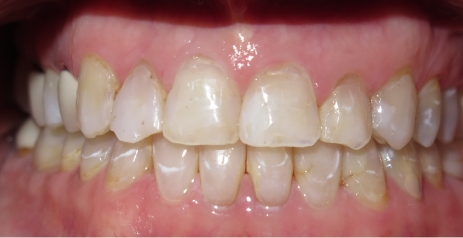 Close up of imperfect teeth before dental treatment