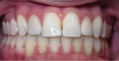 Close up of flawless teeth after dental treatment