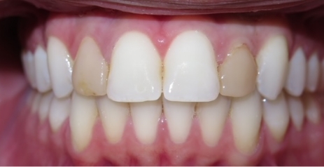 Close up of imperfect teeth before dental treatment