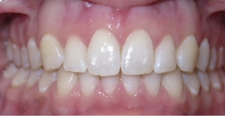 Close up of flawless teeth after dental treatment