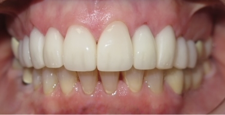 Close up of flawless teeth after dental treatment