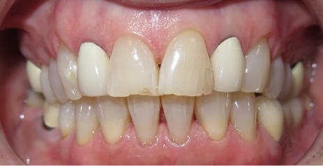 Close up of imperfect teeth before dental treatment