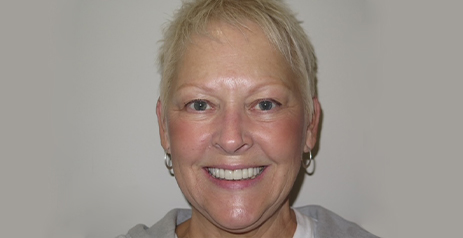 Woman smiling after dental treatment