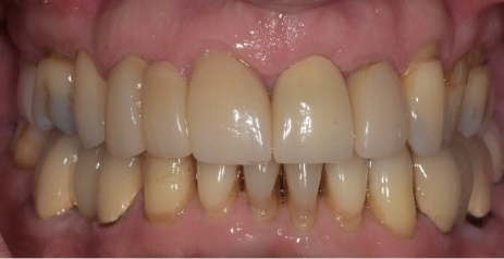 Close up of flawless teeth after dental treatment