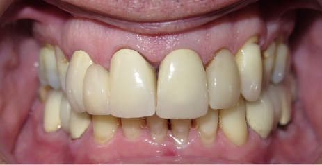 Close up of imperfect teeth before dental treatment