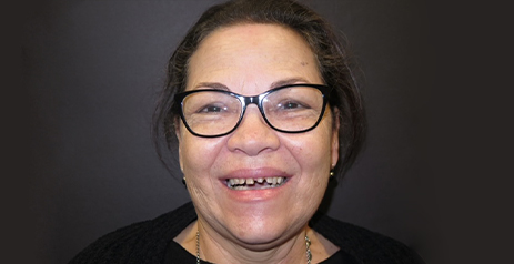 Woman grinning before dental treatment