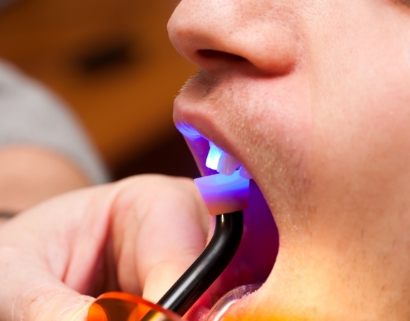 Close up of dental patient receiving bonding on a front tooth