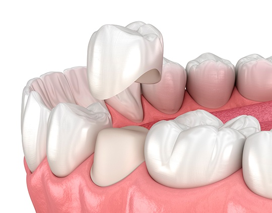 Digital image of a dental crown being put into place