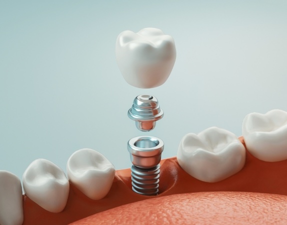 Illustrated dental crown being placed onto a dental implant