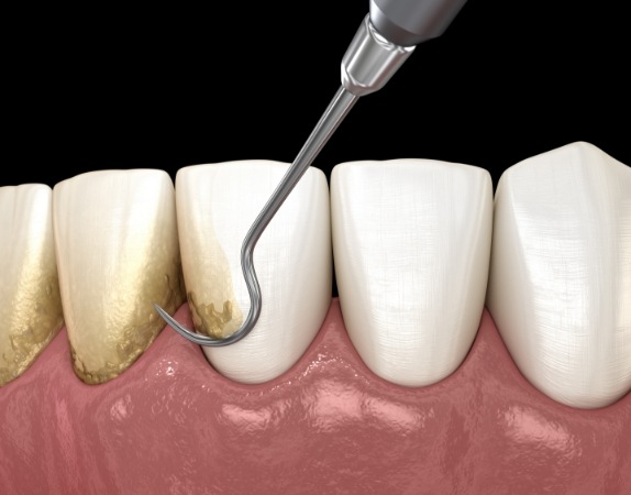 Illustrated dental tools clearing plaque off of teeth