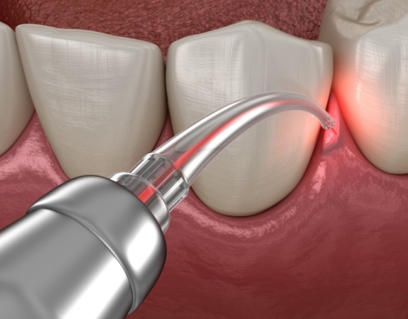 Soft tissue laser treating gum disease