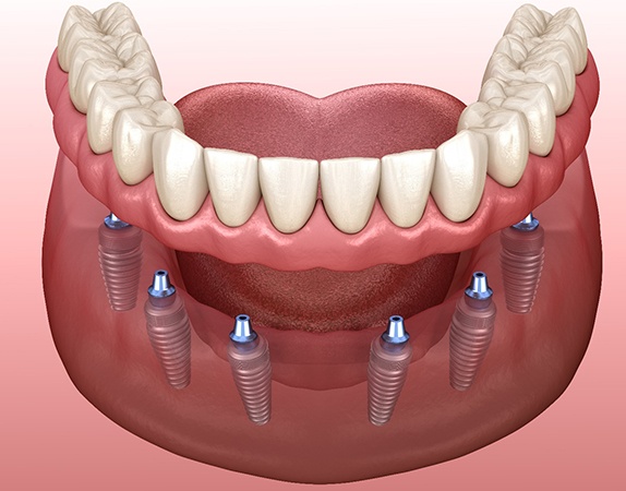 Digital illustration of implant dentures