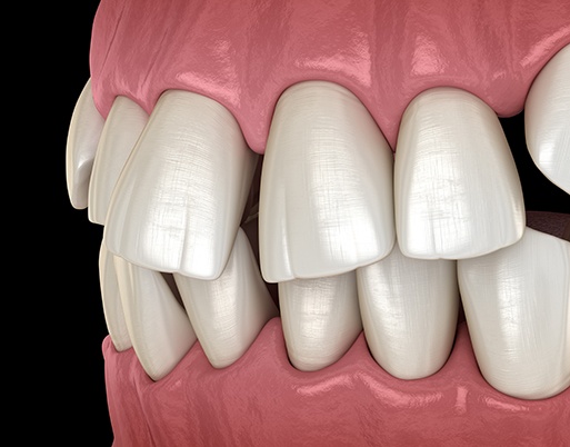 Illustration of gapped teeth