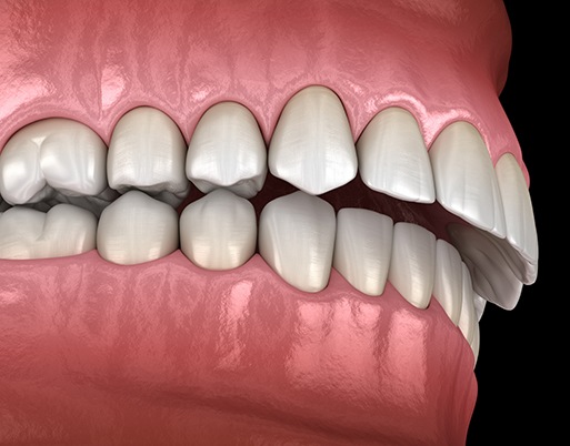Illustration of a crossbite