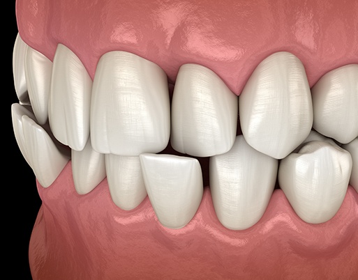 Smiling woman holding an Invisalign tray outdoors