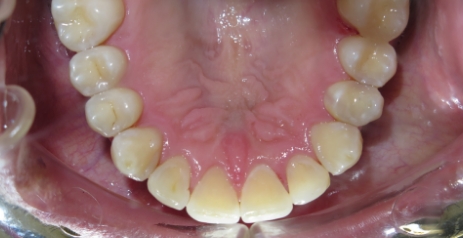 Close up of straightened teeth after Invisalign