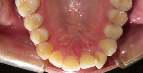 Close up of misaligned teeth before Invisalign