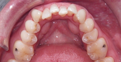 Close up of misaligned teeth before Invisalign