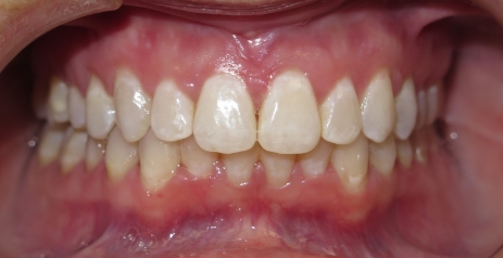 Close up of straightened teeth after Invisalign