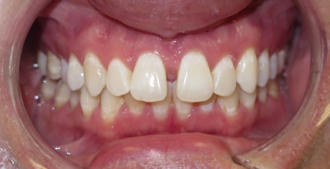 Close up of misaligned teeth before Invisalign