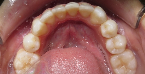 Close up of straightened teeth after Invisalign