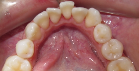 Close up of misaligned teeth before Invisalign