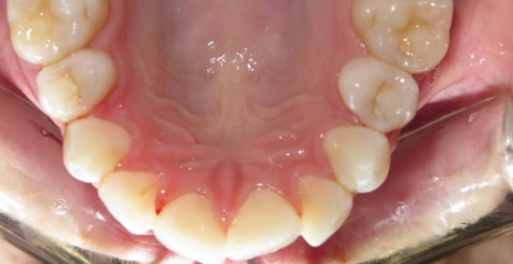 Close up of misaligned teeth before Invisalign