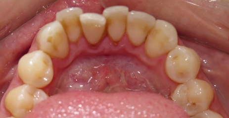 Close up of misaligned teeth before Invisalign