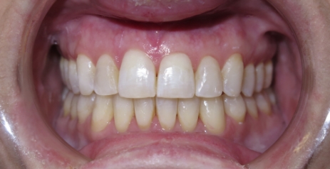 Close up of straightened teeth after Invisalign