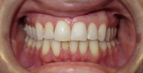 Close up of misaligned teeth before Invisalign
