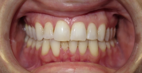 Close up of misaligned teeth before Invisalign